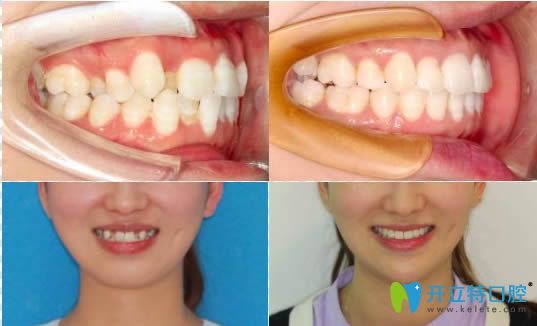 35岁顾客戴牙箍矫正牙齿前后对比效果及脸型变化图