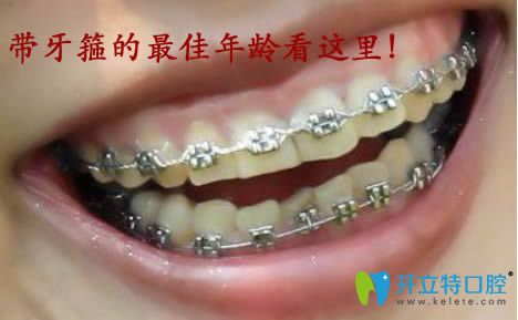 资深牙医生告诉你带牙箍的年龄