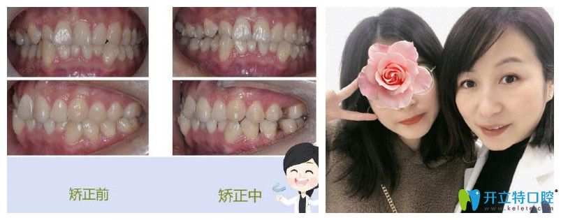 福州维乐口腔郭淑苹牙齿矫正案例