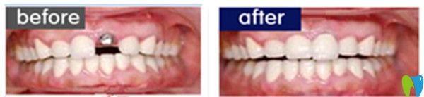 单颗牙齿缺失效果图