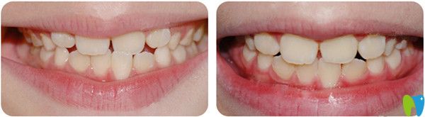 个别牙反颌治疗前后对比