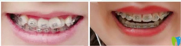 吉林爱齿口腔牙齿矫正前后对比图