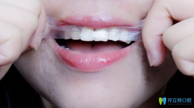 网红亲身体验反馈：美白牙贴有用吗
