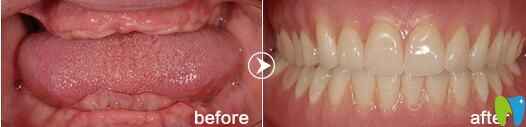 深圳格伦菲尔口腔全口牙种植案例前后效果对比