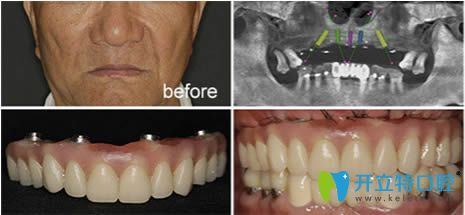 南京博韵口腔全口种植牙及牙齿矫正前后对比案例分享