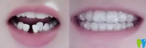 淄博海全口腔隐形牙齿矫正案例