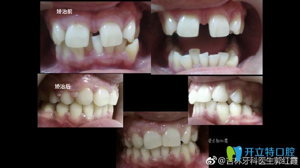 牙齿缝隙过大矫正前后对比图