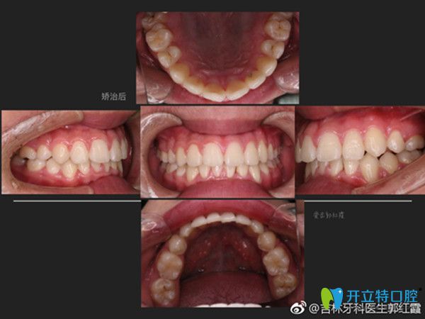 牙齿拥挤矫正后效果图