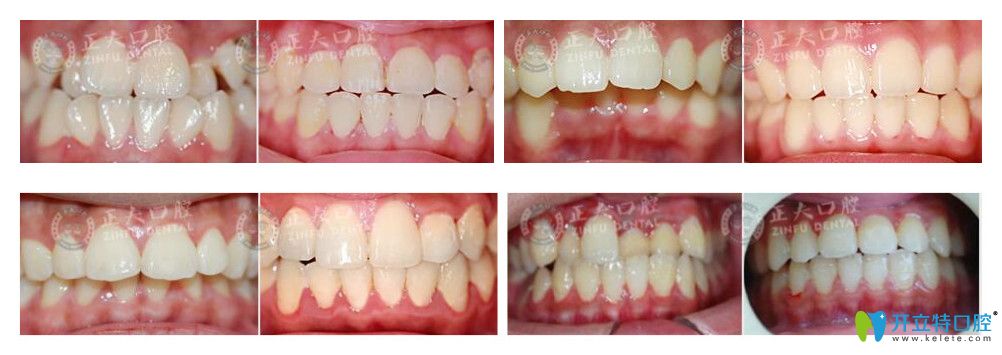 深圳正夫口腔徐国强lh魔法丝矫正案例效果对比图