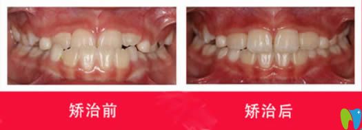 西安中诺口腔张孜儿童地包天选择MRC肌功能矫正前后对比效果