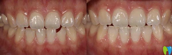 下颌前牙牙体缺损修复效果图