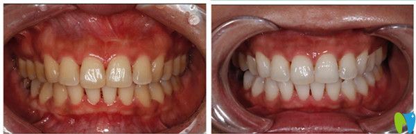 冷光美白前后变化图