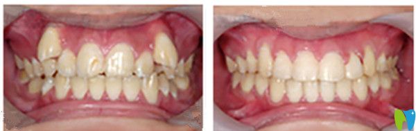 吉林爱齿口腔郭旭磊牙齿矫正前后效果图 吉林爱齿口腔郭旭磊牙齿矫正前后效果图