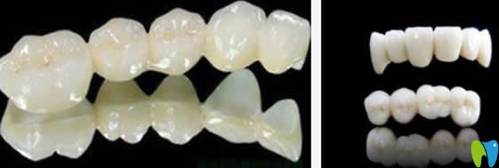牙齿修复选择仿生冠/烤瓷牙/全瓷贴面,他们的区别是...