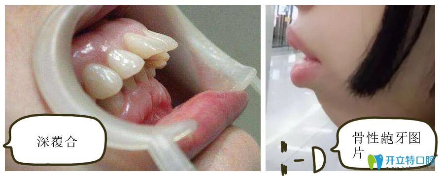 龅牙矫正需要多少钱及骨性龅牙一定要手术吗
