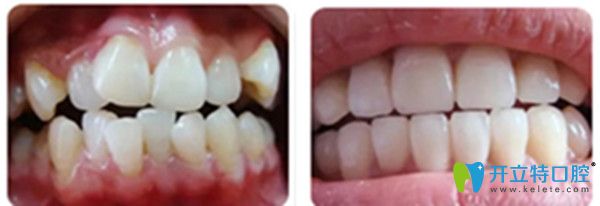 吉林爱齿口腔牙齿矫正对比图 吉林爱齿口腔牙齿矫正对比图