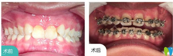 吉林爱齿口腔耿悦牙齿矫正对比图