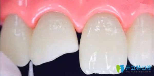 牙齿缺损的危害及修复牙齿缺损的方法
