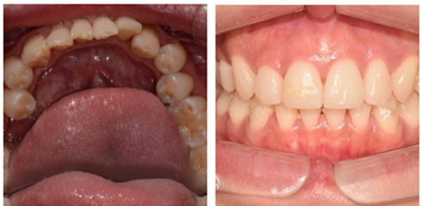 了解种植牙技术后，选择在吉林爱齿口腔做即刻种植