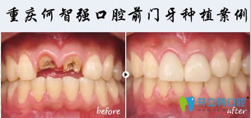 重庆何智口腔前门牙缺失两颗种植后效果图