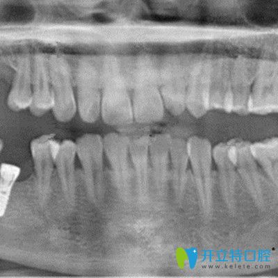 在吉林爱齿口腔做即刻种植牙拍片照片