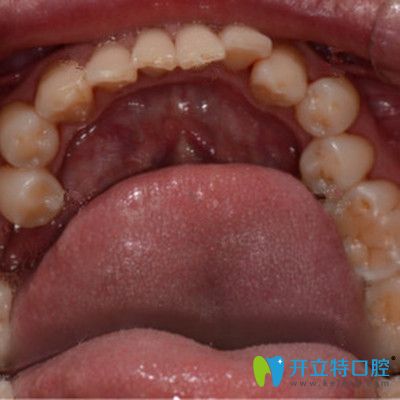 牙齿缺失前的照片