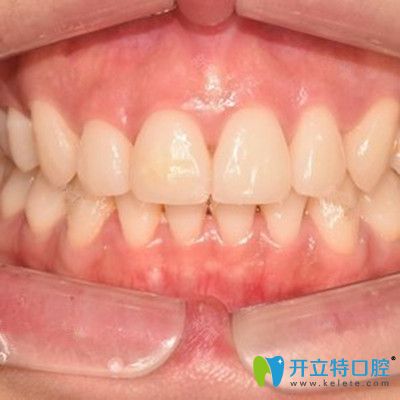 即刻种植牙前后对比照
