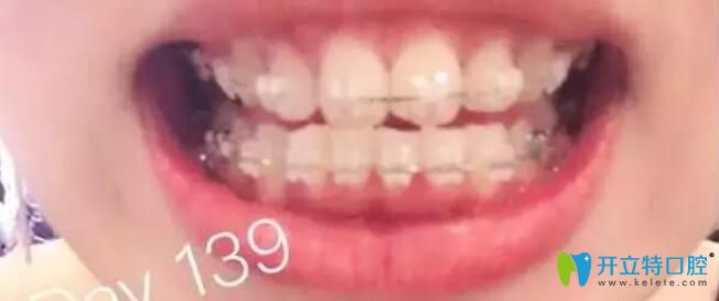 牙齿矫正第139天变化图
