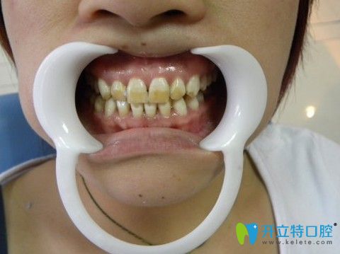 淄博海全口腔扒了多种牙齿美白方法,我选择做超薄牙齿贴面修复氟斑牙