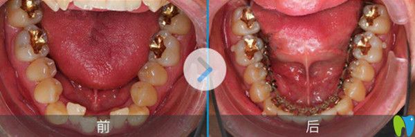 舌侧隐形矫正前后效果图