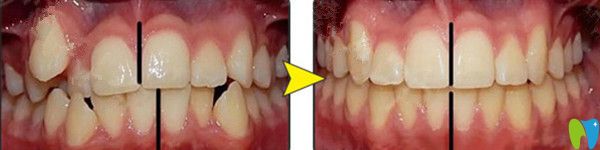 金属托槽矫正前后对比图