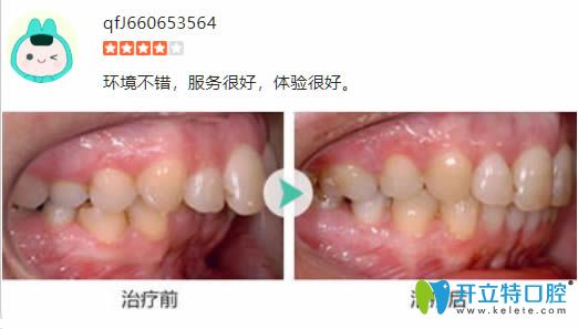 28岁顾客在丽江锦美口腔做完龅牙矫正前后对比效果