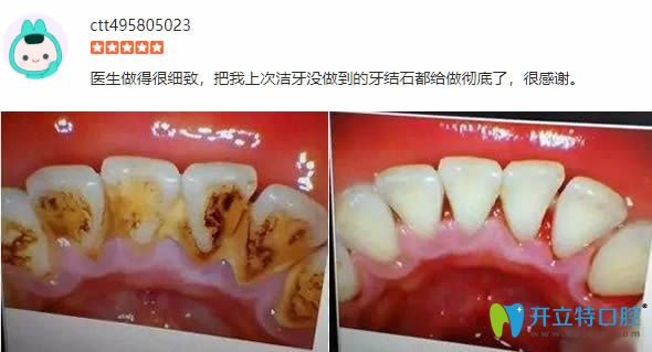 顾客在丽江锦美体验洗牙后前后对比照