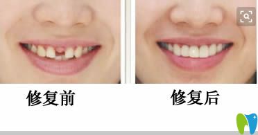 朱锦锋医生前门牙修复前后对比图