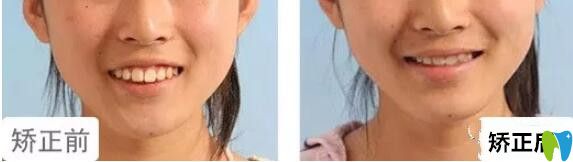 格伦菲尔口腔水平如何?14女孩上牙前突矫正<span style= 格伦菲尔口腔水平如何?14女孩上牙前突矫正<span style=