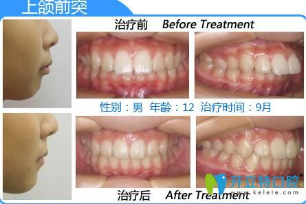 深圳格伦菲尔口腔好吗?12岁男孩龅牙矫正<span style= 深圳格伦菲尔口腔好吗?12岁男孩龅牙矫正<span style=
