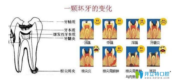 虫牙怎么形成过程图图片