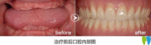 格伦菲尔口腔怎么样?老年人全口牙缺失种植<span style= 格伦菲尔口腔怎么样?老年人全口牙缺失种植<span style=