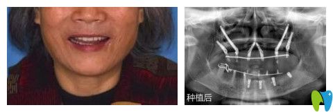 南京博韵口腔陈慧玲给林阿姨做穿颧骨种植牙术后照片