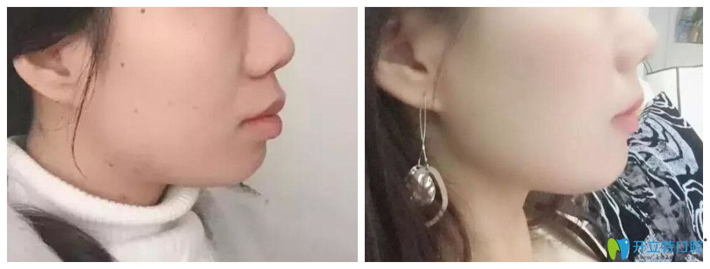 艾芳口腔嘴突龅牙顾客矫正案例前后对比图