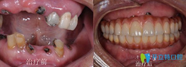 All-on-4种植牙全口重建病例
