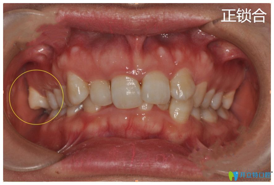 浅谈锁合牙的治疗方法及牙齿锁合矫正步骤