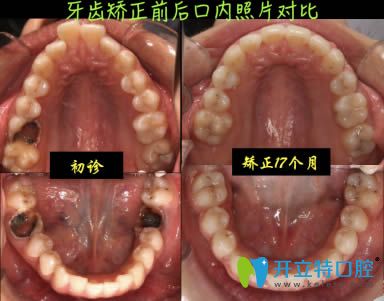 南阳康泽口腔牙齿正畸治疗效果对比图