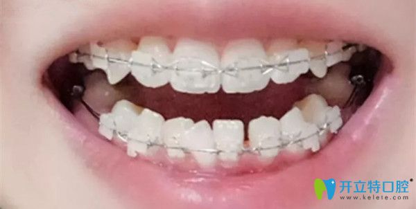 牙齿矫正半年后的效果图