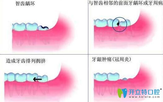 尽头牙是正常萌出发炎如何治疗