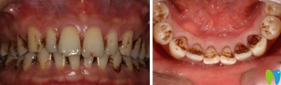  求助!牙齿烟斑怎么去除,单洗牙能去掉吗？