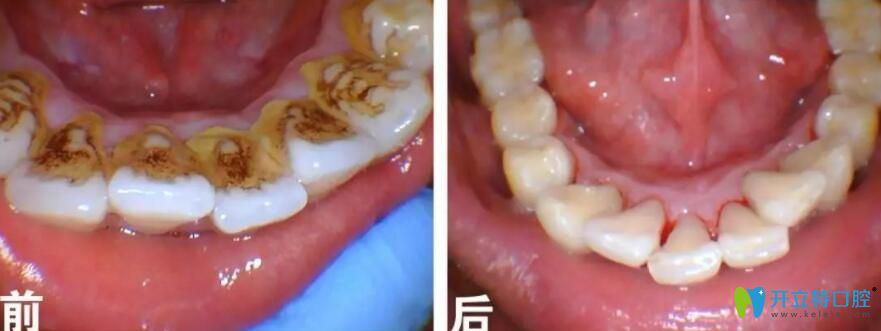 牙齿烟斑冷光美白前后对比图