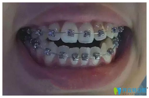 我在重庆鹏博口腔做金属牙齿托槽牙齿矫正第4个月