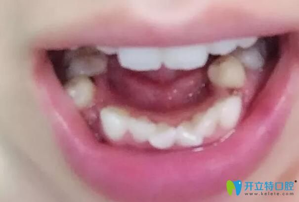 中山禾佳口腔虎牙、牙齿拥挤不齐,在中山禾佳口腔做矫正后42天变化很大