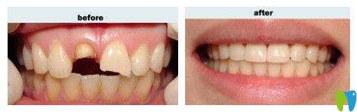 重庆鹏博口腔陈亮医生前牙缺损修复效果
